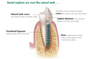 Dental Implants-Dentist in Atascadero